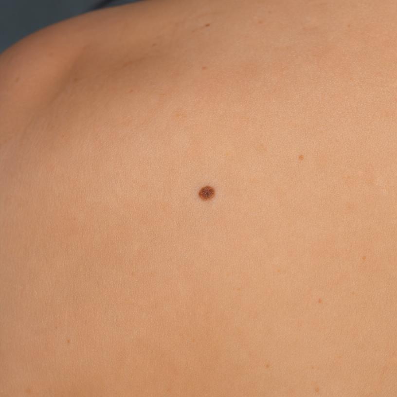 Clinical close-up of a pigmented lesion on the left scapula